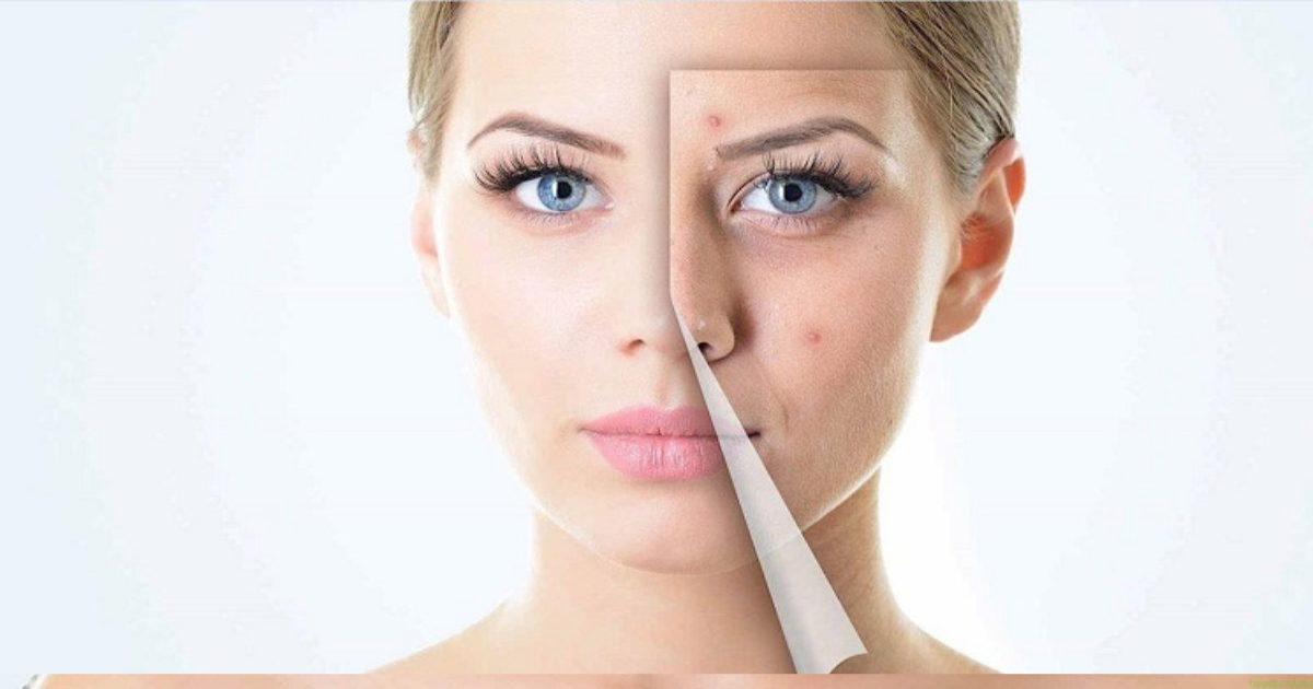 หยิบของในบ้านมารักษาสิว ยุบเร็วจนต้องร้องว้าว