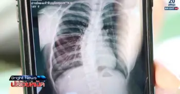 กระดูกสันหลังคด