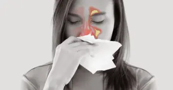 ภูมิแพ้