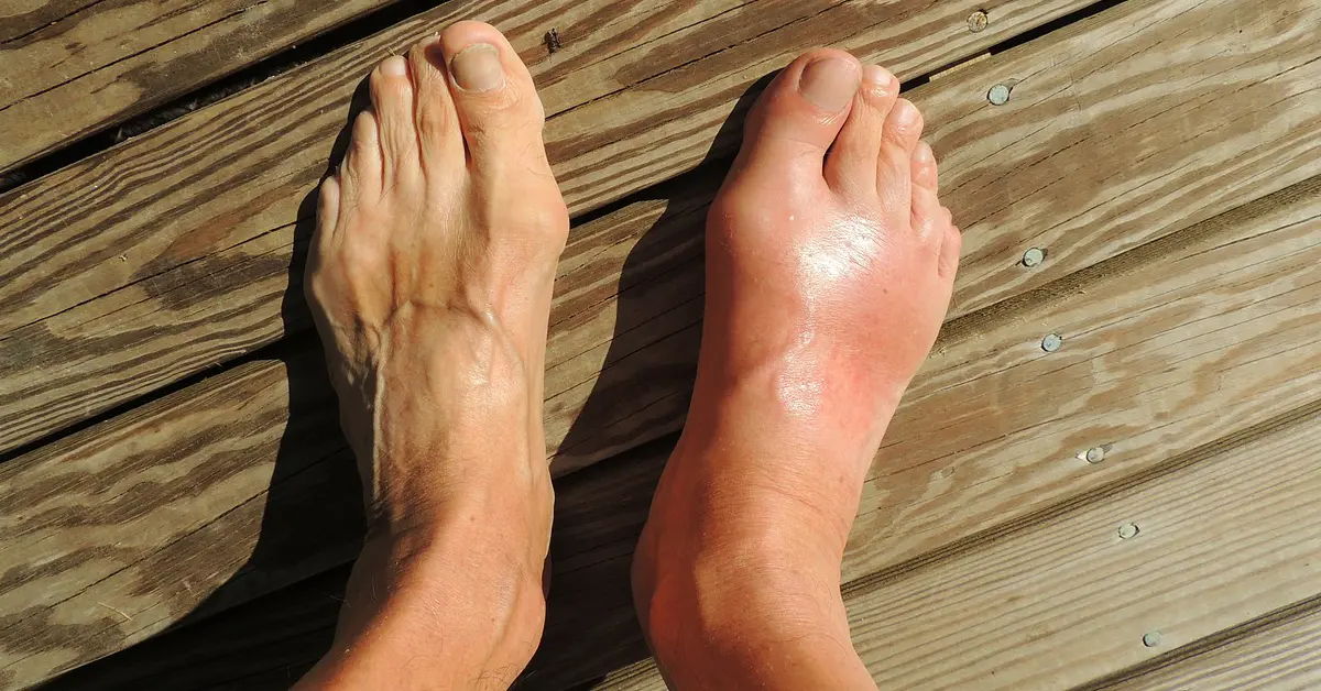 โรคเกาต์