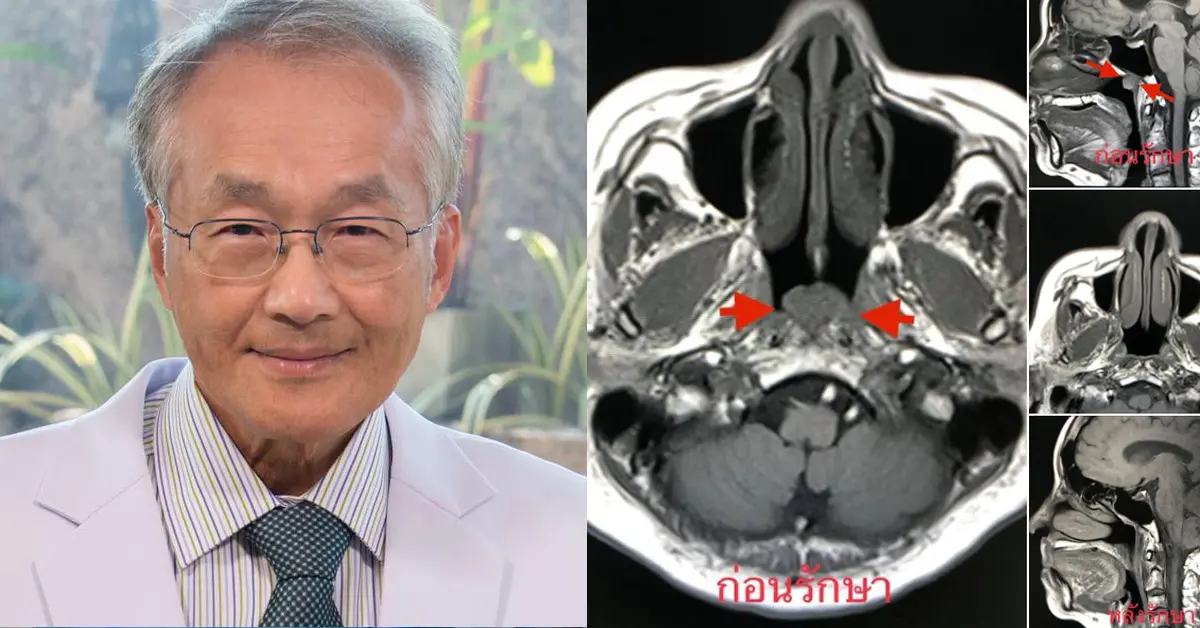 วัณโรคหลังโพรงจมูก