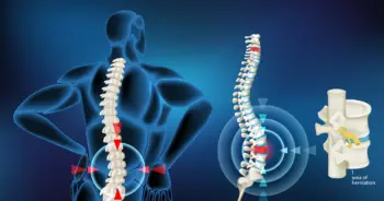 หมอนรองกระดูกทับเส้นประสาท