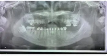 ดัดฟันแฟชั่น 11