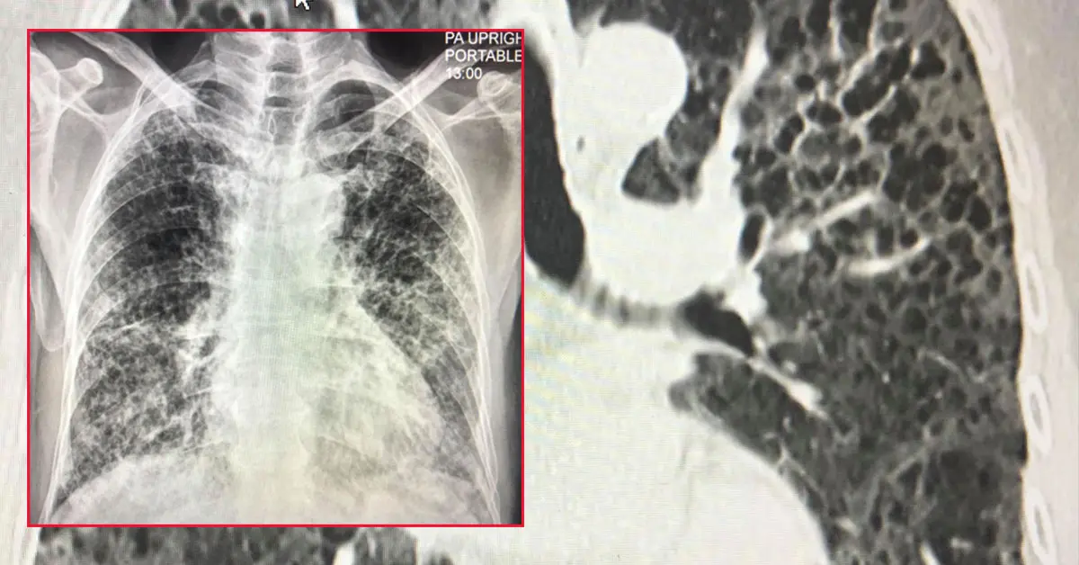 ปอดเป็นฝ้า สายพันธุ์อัลฟา