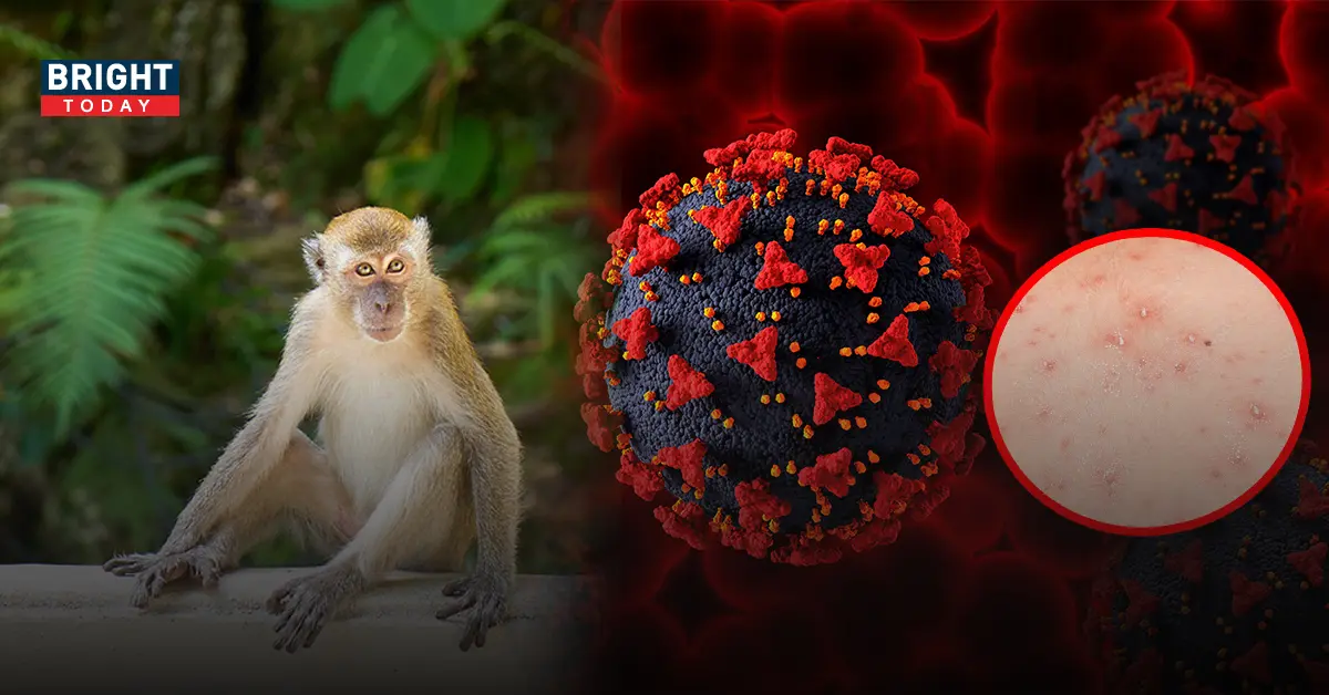 ฝีดาษลิง โควิด-19 ป้องกันต่างกันอย่างไร