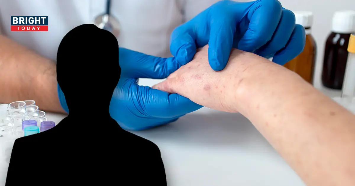 ฝีดาษลิง