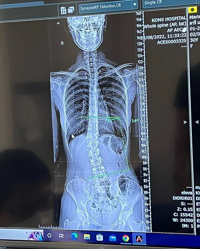 -มารี-กระดูกสันหลัง-4