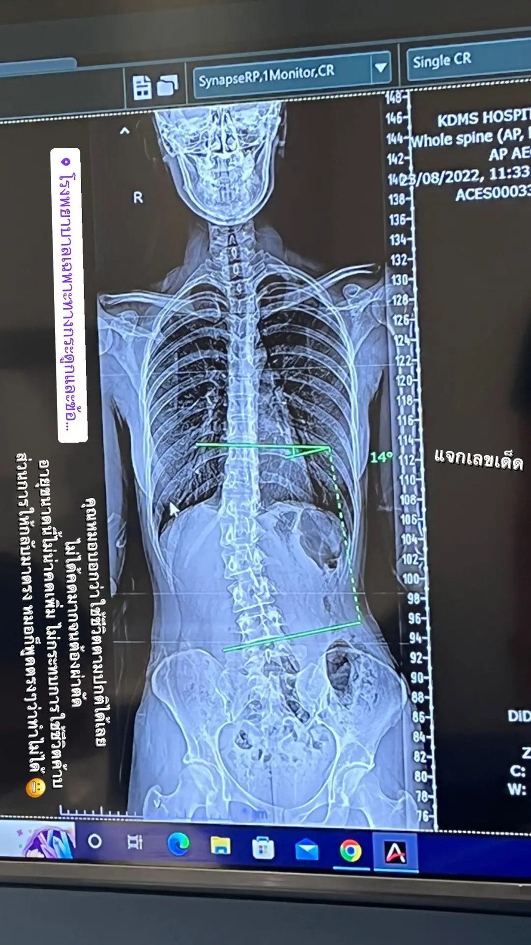ส้ม-มารี-กระดูกสันหลัง-2