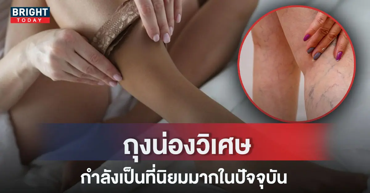 ปกเส้นเลือดขอด