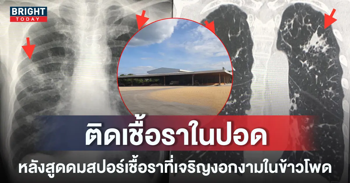 -เชื้อราจากเมล็ดข้าวโพดลงปอด