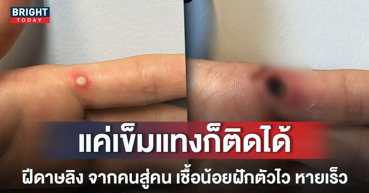 -ฝีดาษลิง