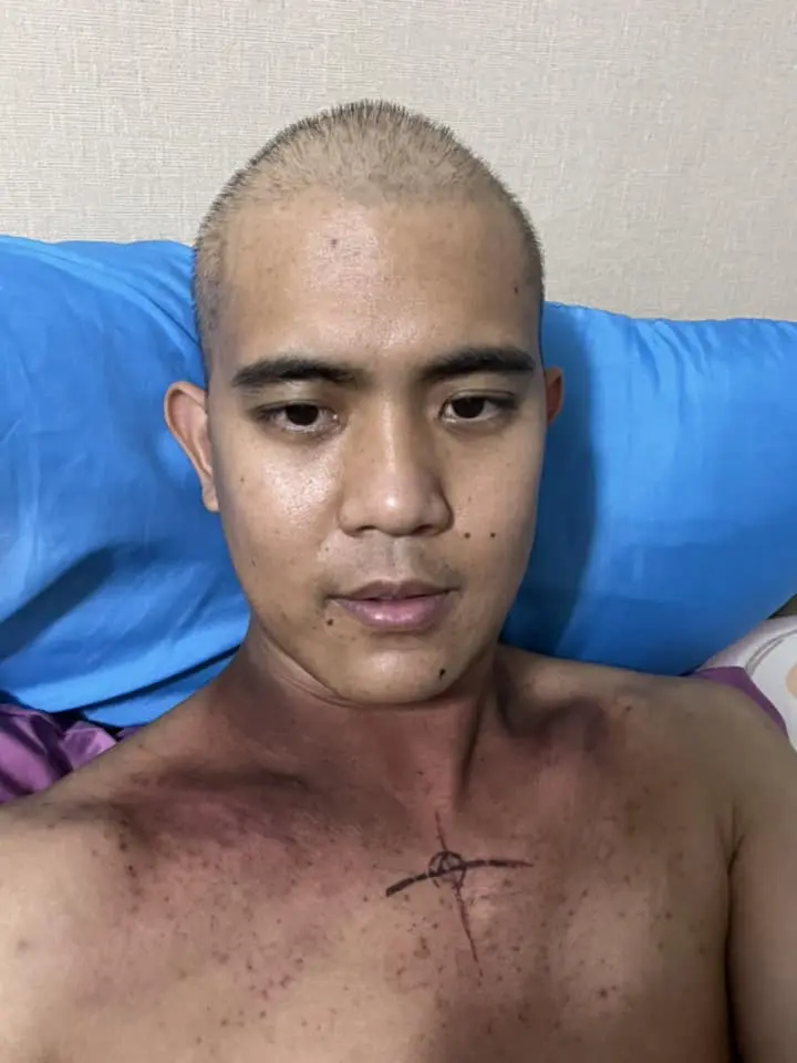 มะเร็งปอด-8
