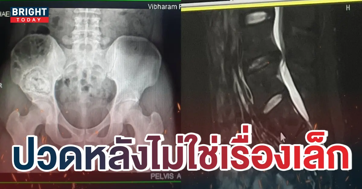 หน้าปกใหม่-ปวดหลังอย่าชะล่าใจ