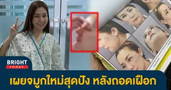 สุดดีใจ-เอ็ม-บุษราคัม-เผยจมูกใหม่สุดปัง-พุ้งสวยมาก-หลังถอดเฝือก