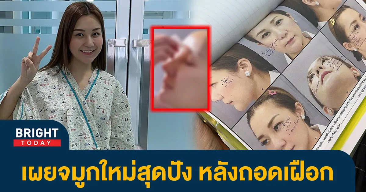 สุดดีใจ-เอ็ม-บุษราคัม-เผยจมูกใหม่สุดปัง-พุ้งสวยมาก-หลังถอดเฝือก
