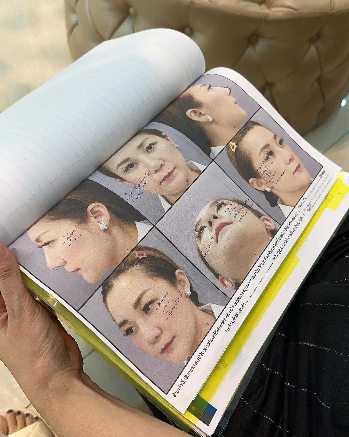 สุดดีใจ-เอ็ม-บุษราคัม-เผยจมูกใหม่สุดปัง-พุ้งสวยมาก-หลังถอดเฝือก-8