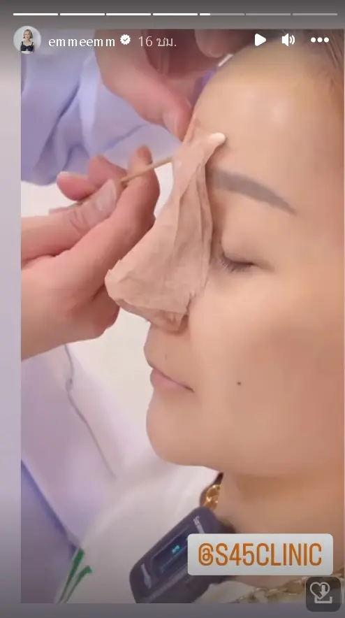 สุดดีใจ-เอ็ม-บุษราคัม-เผยจมูกใหม่สุดปัง-พุ้งสวยมาก-หลังถอดเฝือก-5