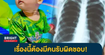 ปอดอักเสบ-2