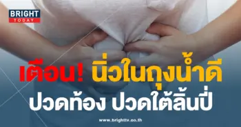 นิ่วในถุงน้ำดี