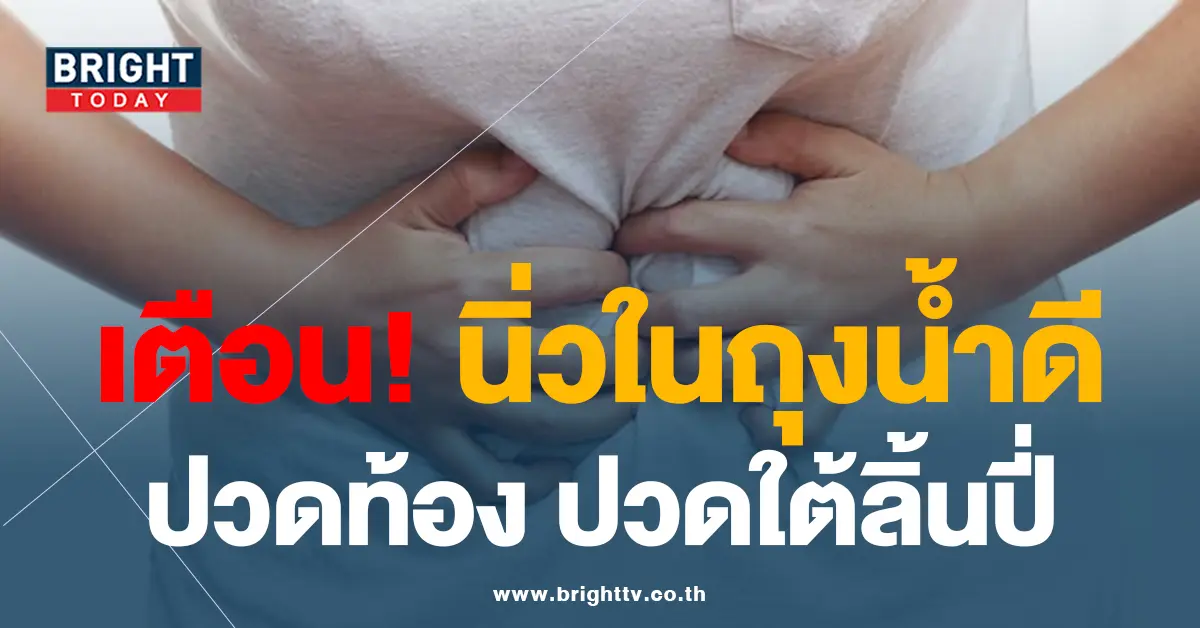 นิ่วในถุงน้ำดี