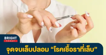เชื้อราที่เล็บ