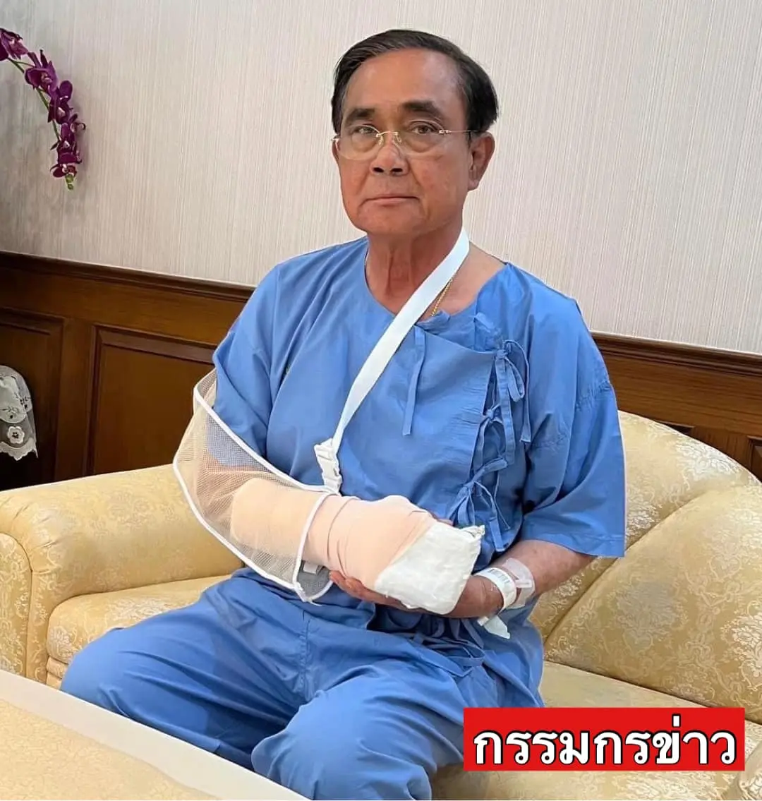 นายกมือบวม