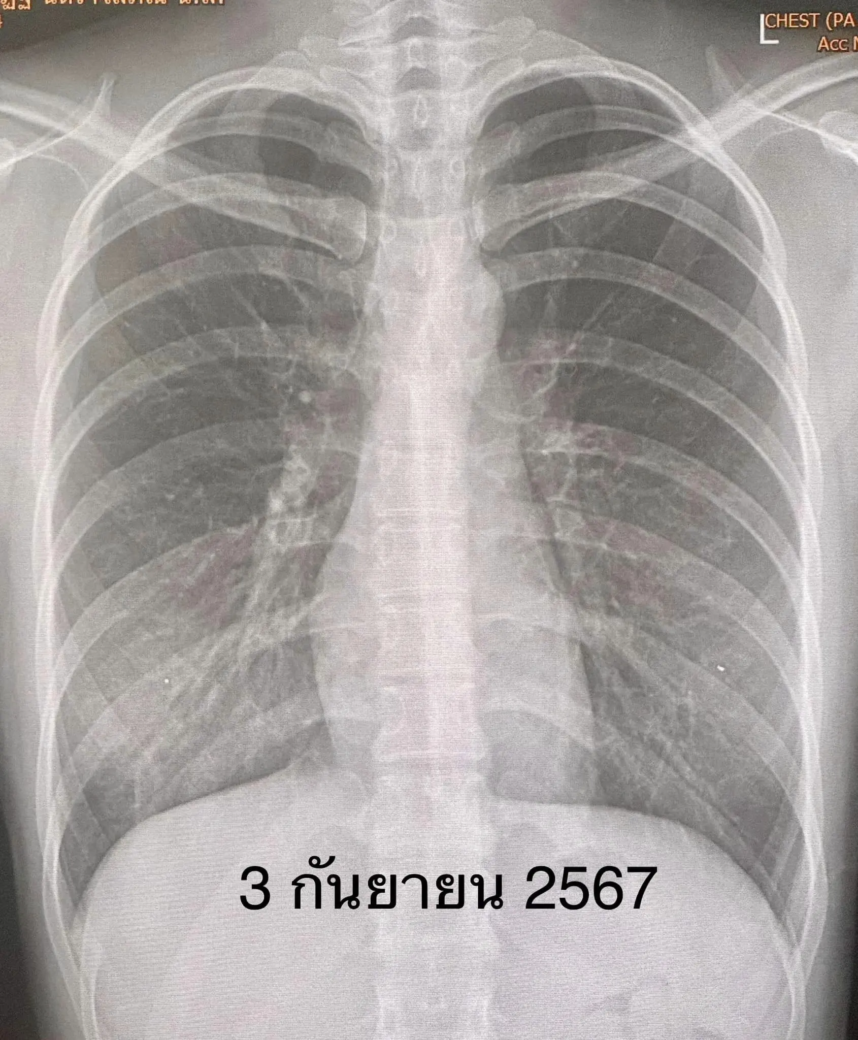 เชื้อแบคทีเรียไมโคพลาสมา-3