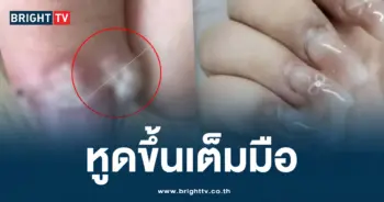 หูด ทำเล็บ