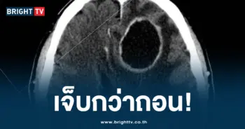 ฟันผุ