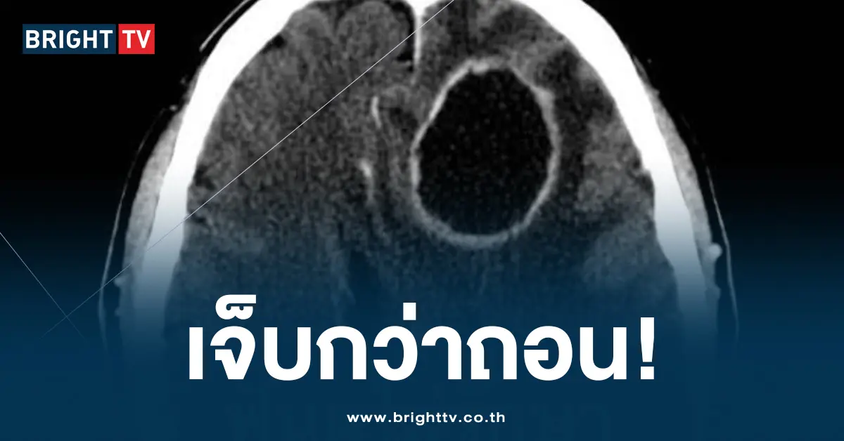 ฟันผุ