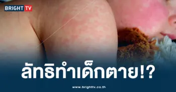 โรคหัด
