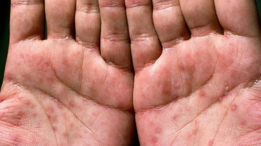 5 จังหวัด ชอบใส่สด เป็น โรคติดต่อทางเพศสัมพันธ์