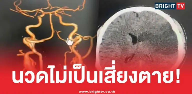 นวดคอ ทำสมองตาย