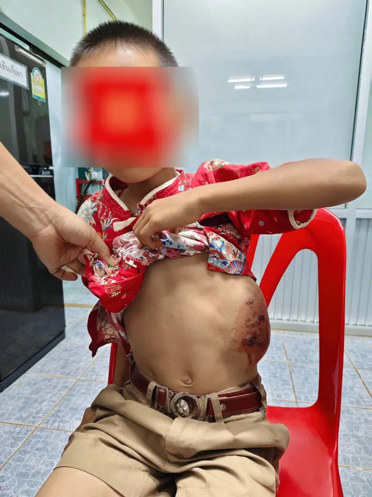 เด็กป่วยก้อนเนื้อ2