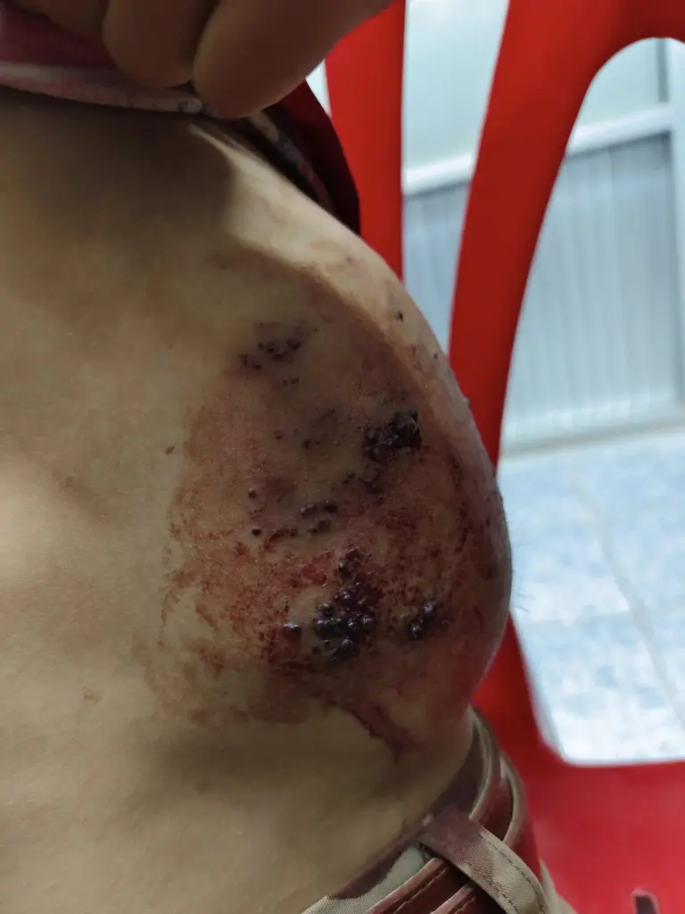 เด็กป่วยก้อนเนื้อ3