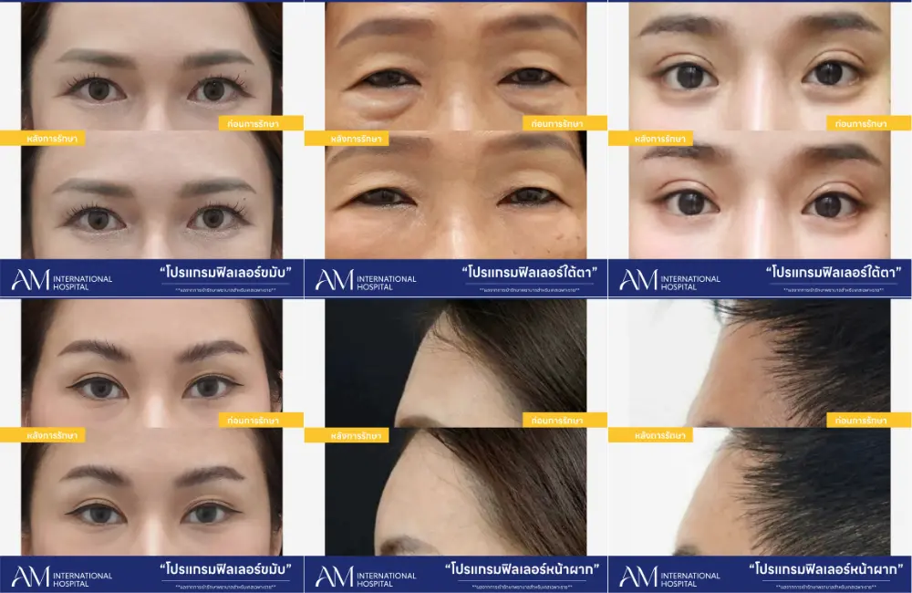 รีวิวผลลัพธ์โปรแกรมฉีดฟิลเลอร์ AM International Hospital