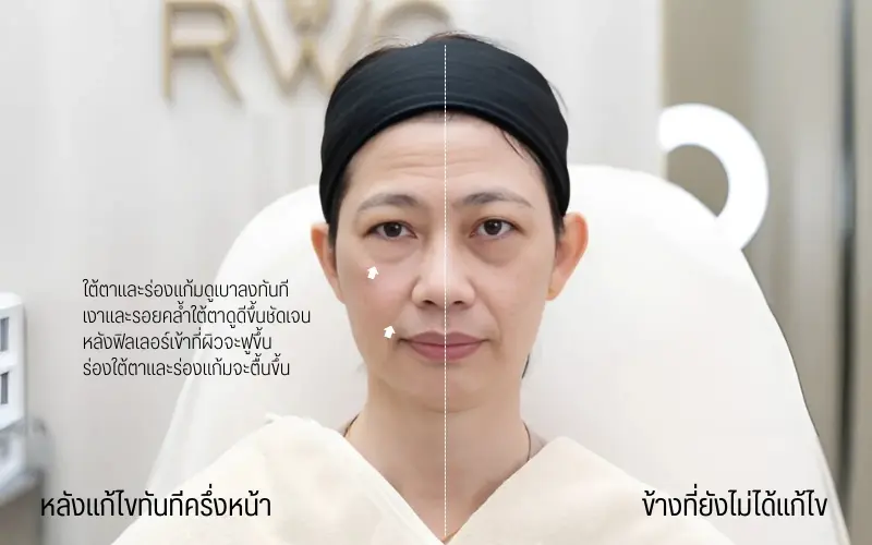 รีวิว RWC Clinic จากลูกค้าปรับลุค ปรับหน้า กับ หมอขมน (3)