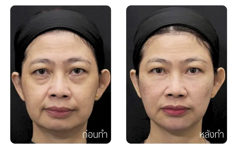 รีวิว RWC Clinic จากลูกค้าปรับลุค ปรับหน้า กับ หมอขมน (4)