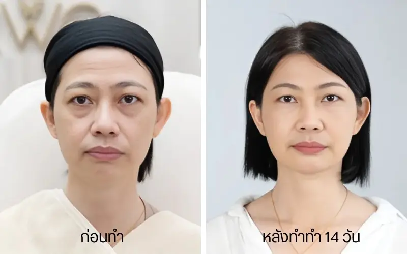 รีวิว RWC Clinic จากลูกค้าปรับลุค ปรับหน้า กับ หมอขมน (5)