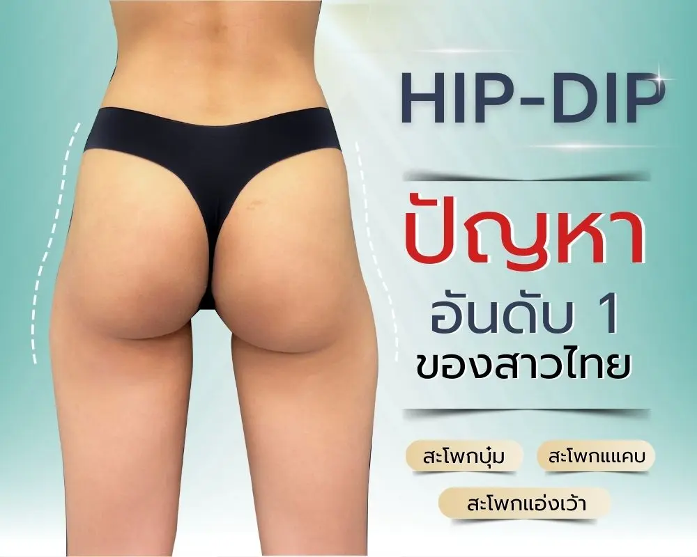 ฟิลเลอร์สะโพก เทคนิคปั้นสะโพก ปั้นสัดส่วน โดน หมอขนมที่ RWC Clinic (1)