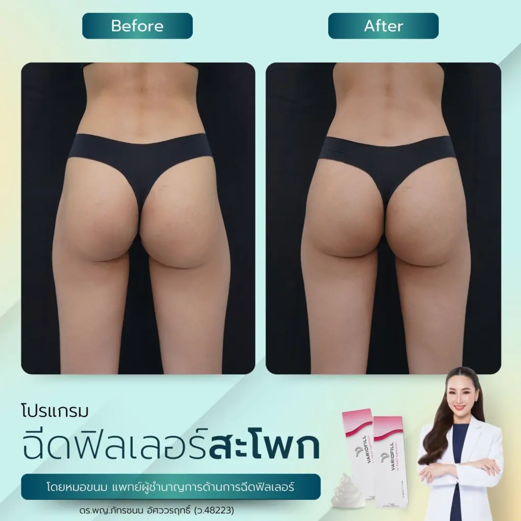 ฟิลเลอร์สะโพก เทคนิคปั้นสะโพก ปั้นสัดส่วน โดน หมอขนมที่ RWC Clinic (7)