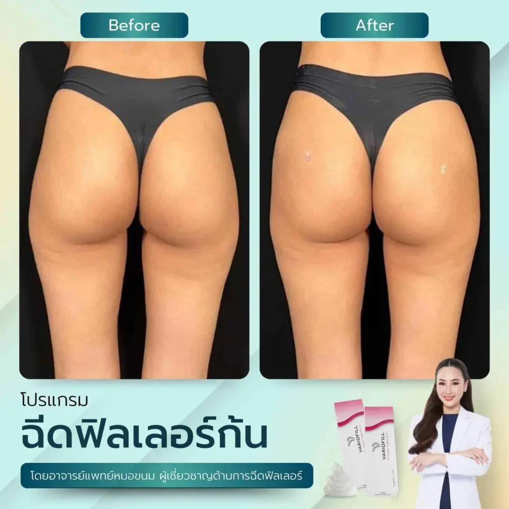 ฟิลเลอร์สะโพก เทคนิคปั้นสะโพก ปั้นสัดส่วน โดน หมอขนมที่ RWC Clinic (8)