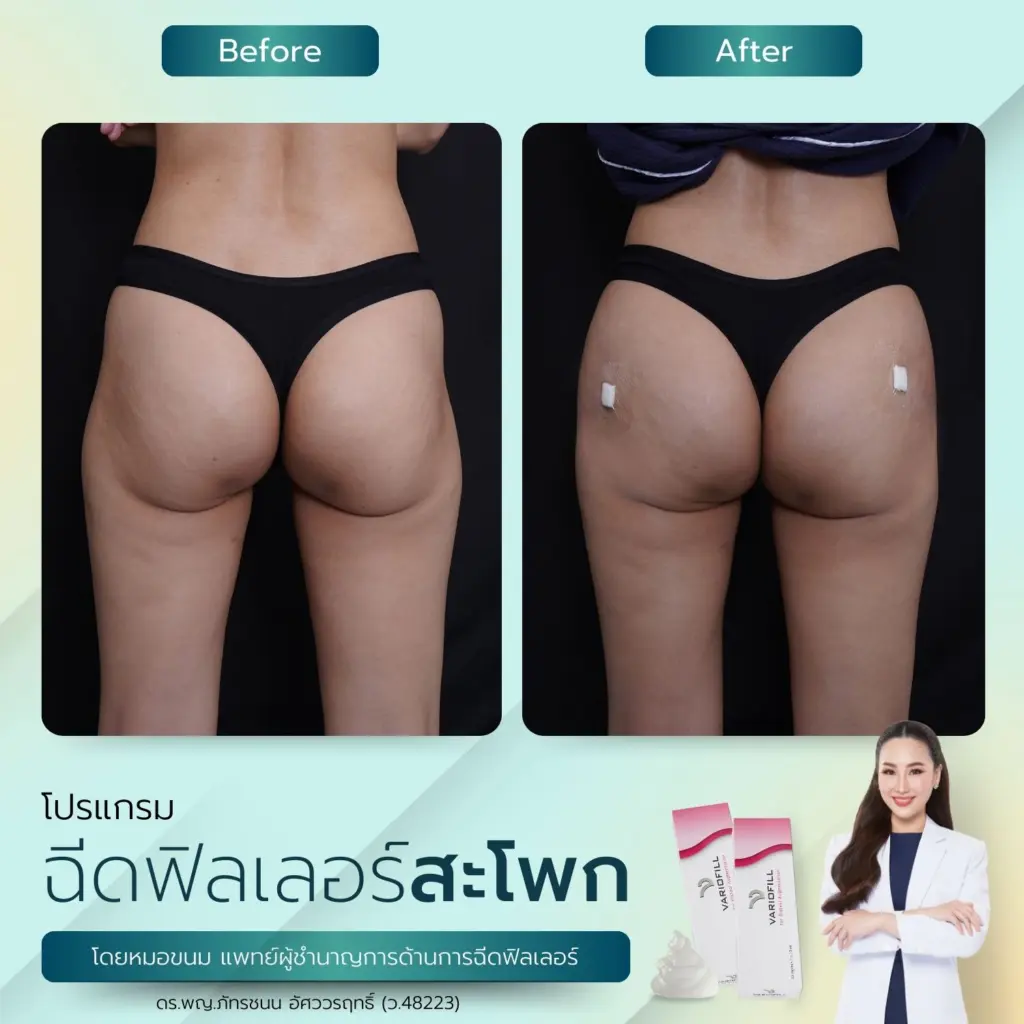 ฟิลเลอร์สะโพก เทคนิคปั้นสะโพก ปั้นสัดส่วน โดน หมอขนมที่ RWC Clinic (9)