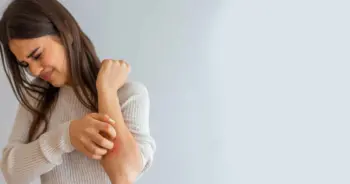 อาการเริ่มต้นของโรคสะเก็ดเงิน