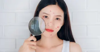 วัยรุ่น–วัยทำงาน หาคลินิกดูแลผิวที่มีบริการด้านสิว เข้าถึงง่าย