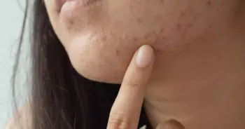 รู้ทันต้นเหตุสิวผด พร้อมวิธีรักษาให้หายไว ไม่กลับมาเป็นอีก