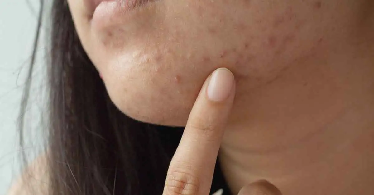 รู้ทันต้นเหตุสิวผด พร้อมวิธีรักษาให้หายไว ไม่กลับมาเป็นอีก