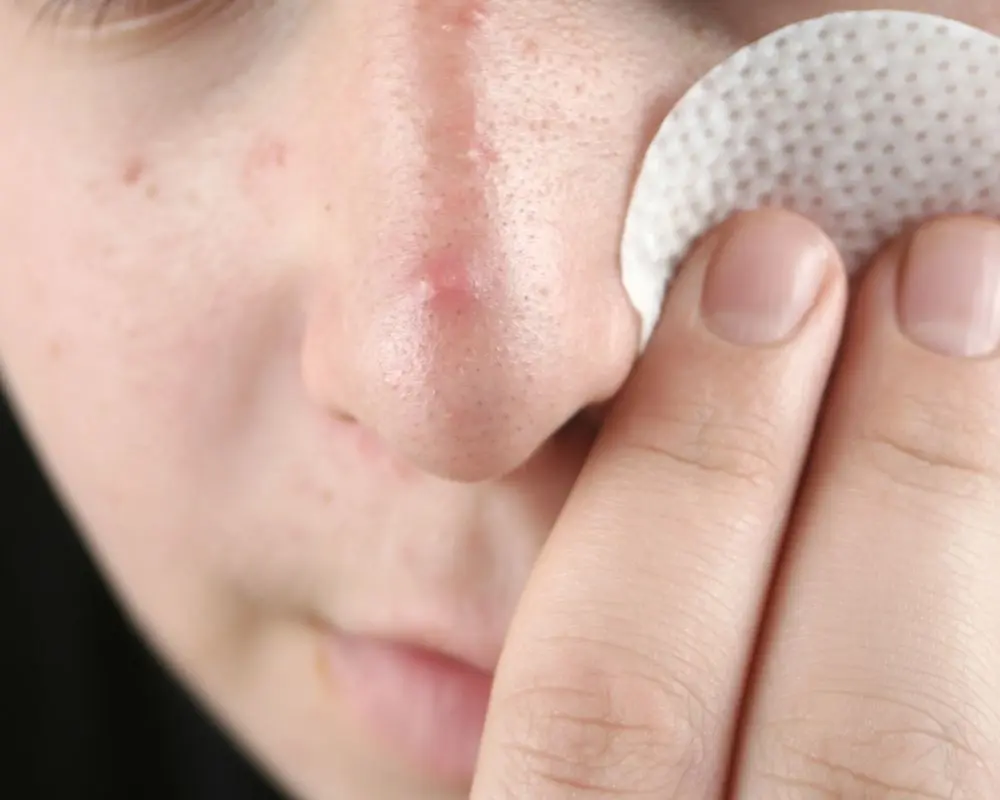 วิธีรักษาสิวที่ช่วยให้ดีขึ้น