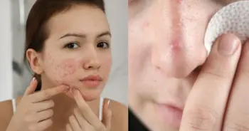 สิวขึ้นไม่หยุดรวมวิธีรักษาให้หายจริง