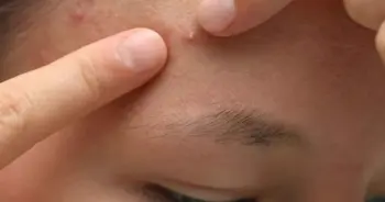 อยากจบปัญหาสิวอุดตัน จำเป็นต้องเลือกวิธีรักษาที่ถูกต้อง